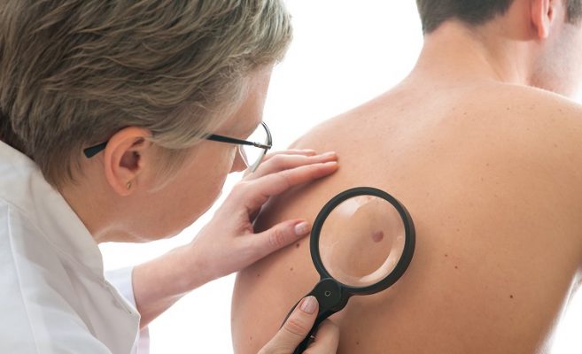Dermatologist examines a mole of male patient