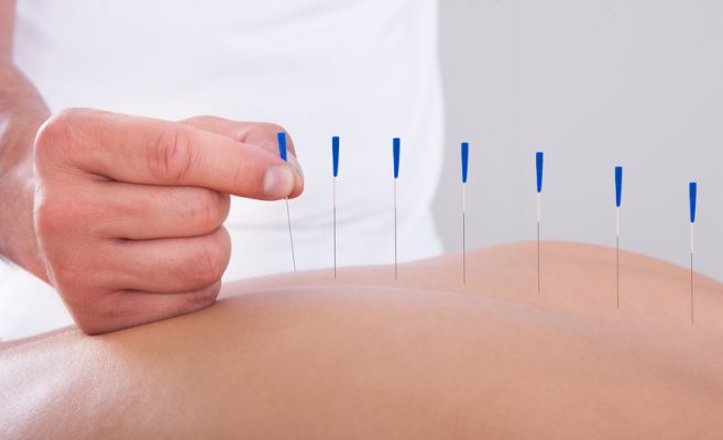 Young Beautiful Woman In An Acupuncture Therapy In A Spa Center